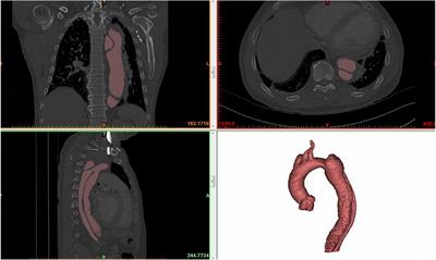 A stable and quantitative method for dimensionality reduction of aortic centerline